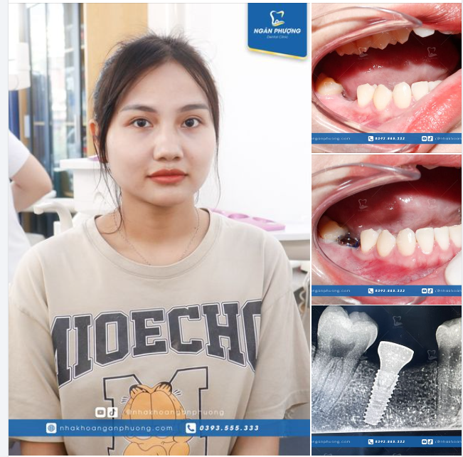 Implant rẻ hơn cầu răng sứ mà chất lượng vượt trội hơn hẳn