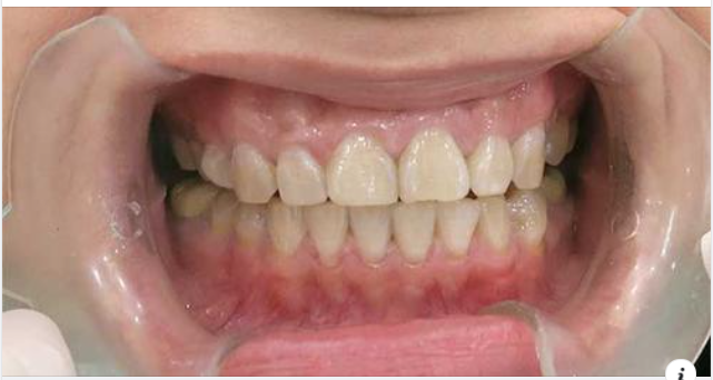 Vì sao phải gắn răng tạm khi trồng răng implant?