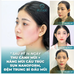 Mũi bạn ấy trước phẫu thuật là đang có cấy chỉ, các bạn nhìn kỹ sẽ thấy sống bị cong vẹo, đầu mũi thô to.