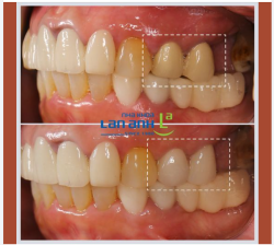 Răng sứ làm tại nhiều nơi khác, làm lại tại nha khoa Lan Anh có giống màu răng sứ không?