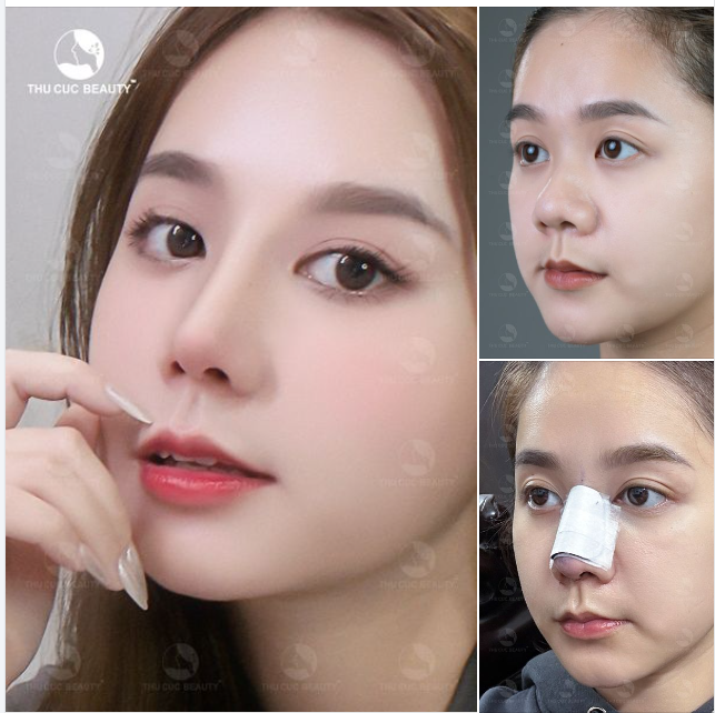 Nâng mũi đẹp đạt chuẩn quốc Tế là đây chứ đâu