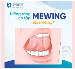 Niềng răng có tập Mewing được không?