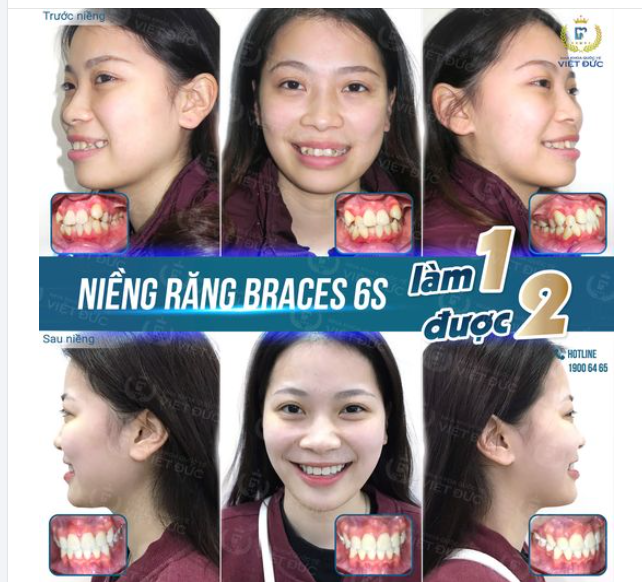 MỪNG NGÀY THÁO NIỀNG: KHÁCH HÀNG NGUYỄN MINH NHẬT