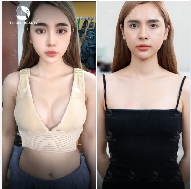 Bạn có muốn loại bỏ V1 teo lép hóa căng tròn tự nhiên ?