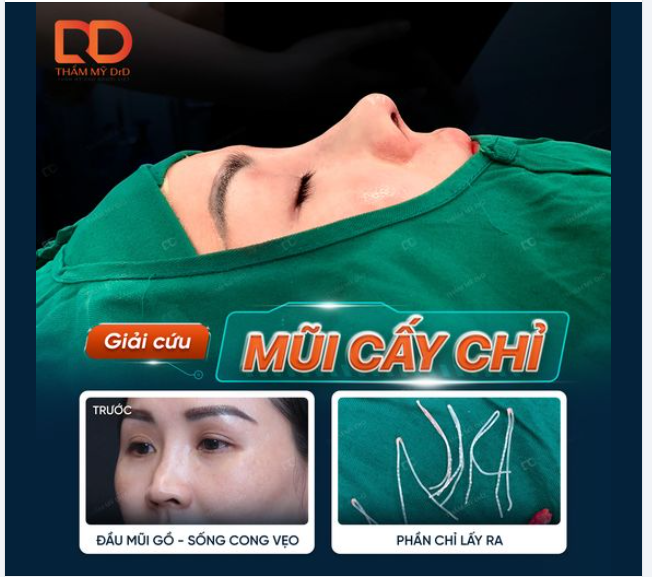 "GIẢI CỨU" THÀNH CÔNG CA MŨI BIẾN CHỨNG DO NÂNG MŨI BẰNG CHỈ