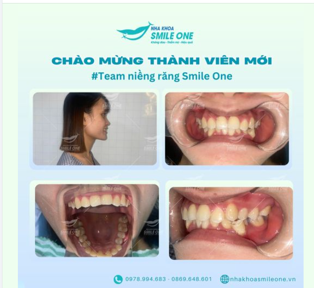 Chào mừng thành viên mới team niềng răng Smile One!
