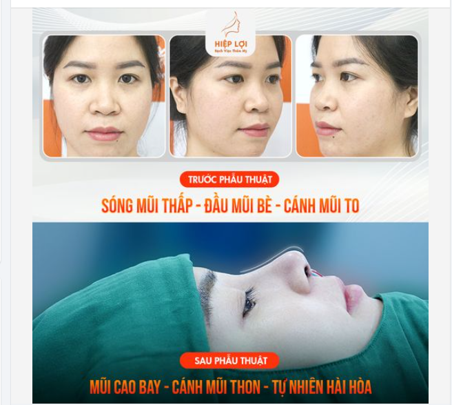 Nếu bạn gặp phải các trường hợp mũi có khuyết điểm như sóng mũi thấp, đầu mũi bè, và cánh mũi to, thì dưới đây là giải pháp dành cho bạn!