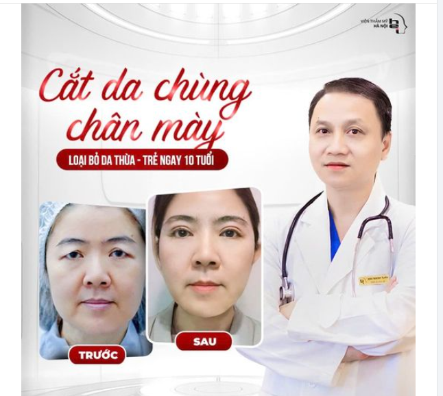 Cắt da chùng chân mày KHÔNG KHÂU DA