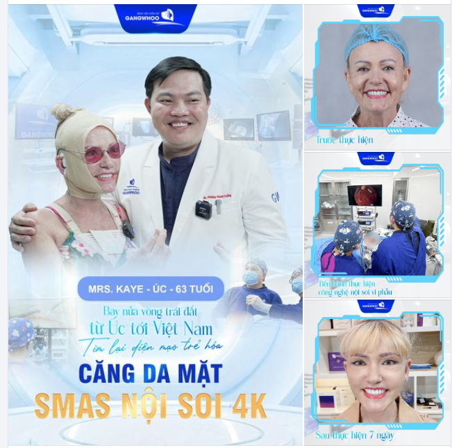 CĂNG DA MẶT SMAS NỘI SOI 4K BAY NỬA VÒNG TRÁI ĐẤT TỪ ÚC VỀ VIỆT NAM TÌM LẠI DIỆN MẠO TRẺ HÓA