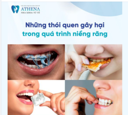 Răng là một bộ phận quan trọng của cơ thể con người đóng vai trò quan trọng trong việc ăn nhai, thẩm mỹ và sức khỏe tổng thể.