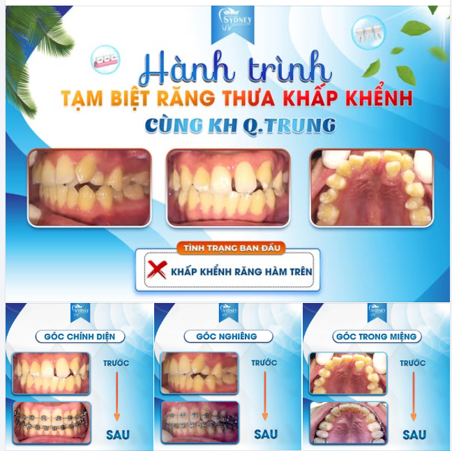 HÀNH TRÌNH TẠM BIỆT RĂNG THƯA KHẤP KHỂNH CÙNG KH Q.TRUNG