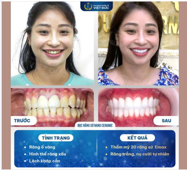 GIẢI PHÁP BỌC RĂNG SỨ NANOCERAMIC – MANG ĐẾN NỤ CƯỜI ĐẸP, CÓ HỒN