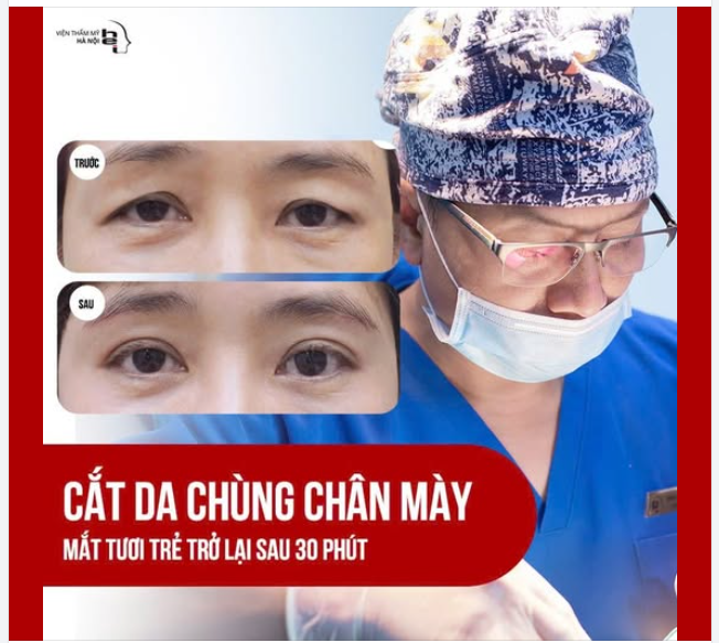 CẮT DA CHÙNG CHÂN MÀY KHÔNG KHÂU DA