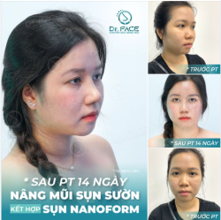 Một chút thay đổi nhờ nâng mũi sụn sườn kết hợp sống nhân tạo Nanoform (sụn sườn để dựng trụ đầu mũi, sụn nhân tạo làm cao sống mũi)