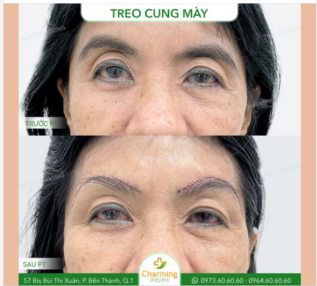 Cô khách của TMV Charming đã lựa chọn phương pháp treo cung mày để khắc phục tình trạng cung mày sụp và vùng mắt bị chảy xệ do dấu hiệu của tuổi tác.