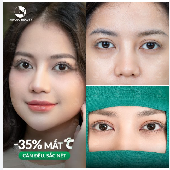 Cắt mí TC tô điểm cho gương mặt thanh tú