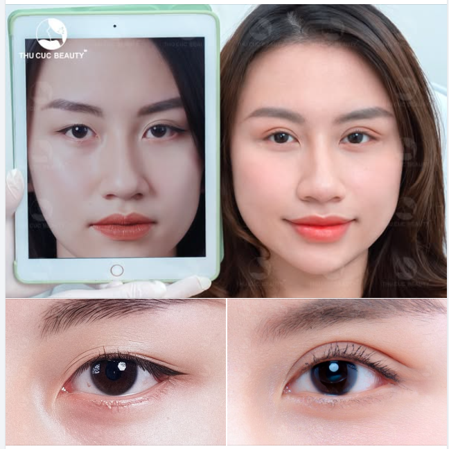 Xóa bỏ ngay nếp mí lờ đờ để trông tươi trẻ tràn đầy sứ sống.
