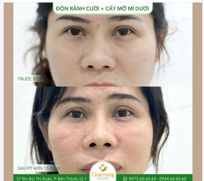 Nàng khách hàng của TMV Charming đã quyết định cải thiện nhan sắc của mình bằng phương pháp độn rãnh cười kết hợp với cấy mỡ mí dưới.