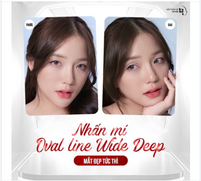 NHẤN MÍ OVAL LINE WIDE DEEP - MẮT ĐẸP HÚT HỒN