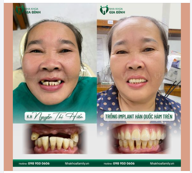 Khôi phục nụ cười rạng rỡ cùng cấy ghép toàn hàm implant Hàn Quốc!