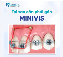 Vì sao cắm minvis khi niềng răng?