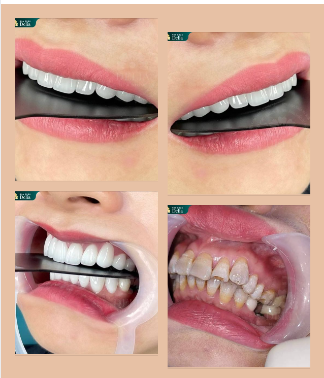 Răng nhiễm tetracycline, mòn cổ răng, sứt mẻ chỉ 48h dưới bàn tay vàng của Bác sĩ Delia và dòng sứ Lava Esthetic của Mỹ, khách hàng có nụ cười mới xinh đẹp hơn.