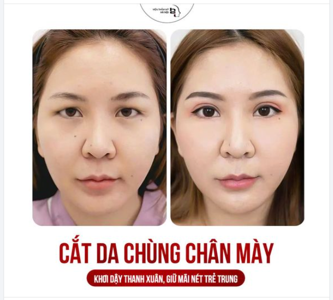 Cắt da chùng chân mày KHÔNG KHÂU DA