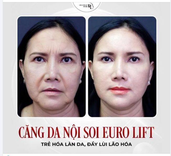 CĂNG DA NỘI SOI EURO LIFT không chỉ đơn thuần là làm trẻ hoá gương mặt mà nó còn mang lại nhiều lợi ích về sức khoẻ cho phụ nữ trung niên.
