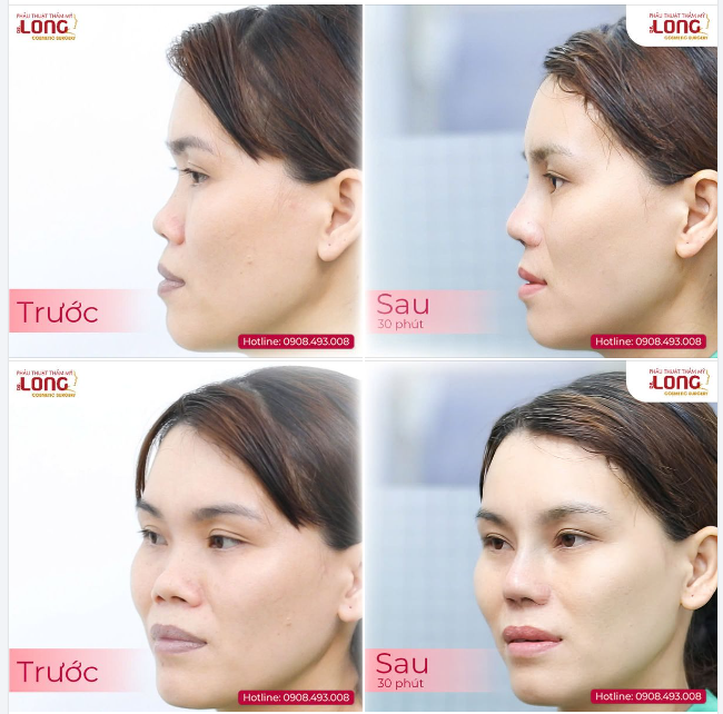 BIẾN ĐỔI DIỆU KỲ CÙNG NÂNG MŨI - SẮC DIỆN TƯƠI TRẺ, MAY MẮN VỀ MÌNH!