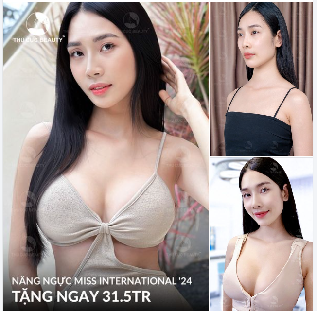 Upsize V1 căng tròn, gợi cảm đầy thu hút  Túi ngực chính hãng. Chạm mềm, hạn chế bao xơ