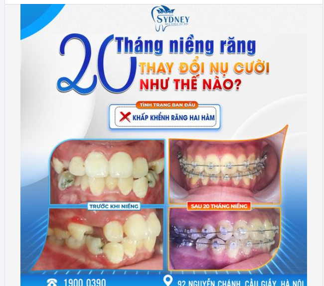 20 THÁNG NIỀNG RĂNG THAY ĐỔI NỤ CƯỜI NHƯ THẾ NÀO?