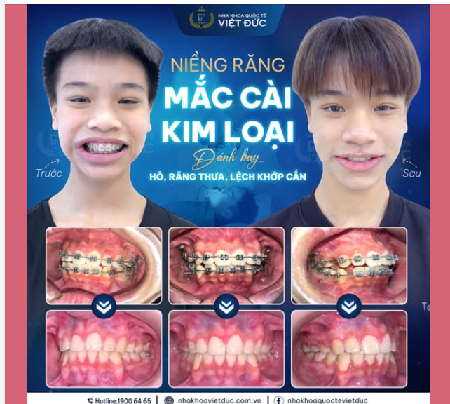 NIỀNG RĂNG LẦN 2 VÀ CÁI KẾT...
