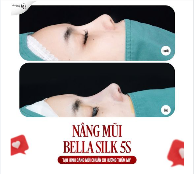 NÂNG MŨI BELLA SILK 5S kiến tạo GÓC NGHIÊNG THẦN THÁNH