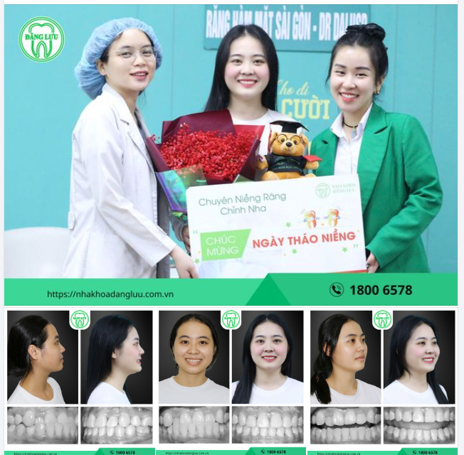 THÁO NIỀNG, CHECK!!!  Chúc mừng Tân Tháo Niềng-er: ThủNgân