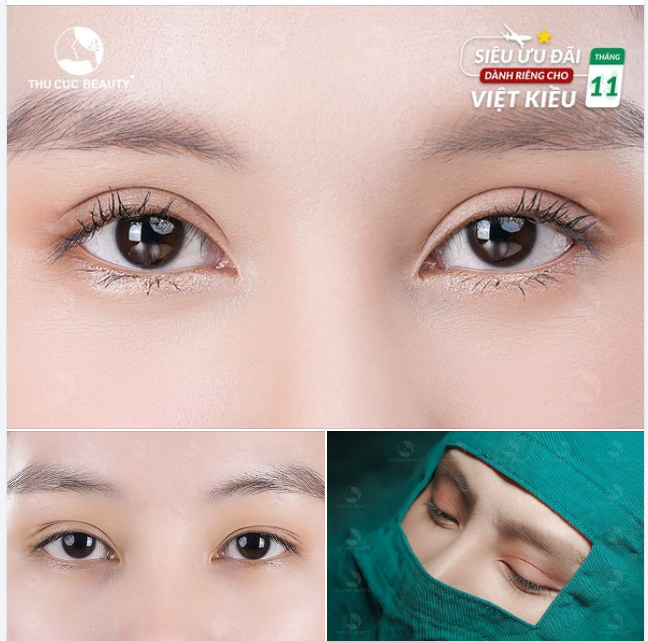 Đôi mắt đẹp theo tiêu chí  - Mí cân đối đẹp tự nhiên