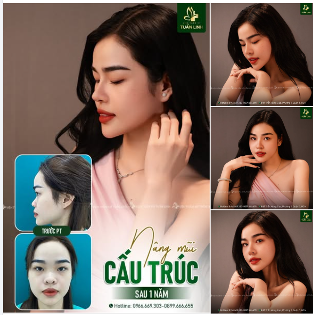 '' Ai cũng khen em làm mũi xinh hơn, đẹp hơn, sắc nét và cuốn hút hơn...'' - Chia sẻ của bé khách sau 1 năm nâng mũi cấu trúc tại Tuấn Linh.