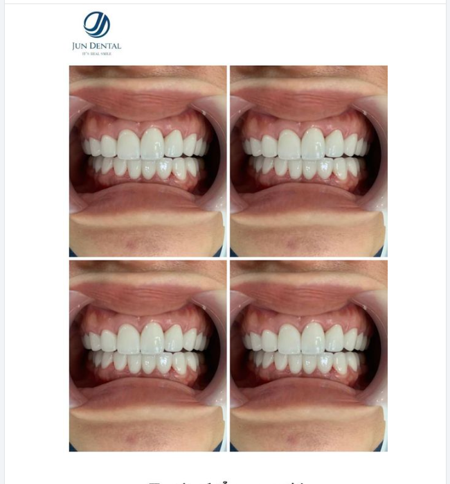 TRỌN VẸN THẨM MỸ, TINH TẾ ĐA CHIỀU CÙNG TUYỆT PHẨM NỤ CƯỜI JUNDENTAL