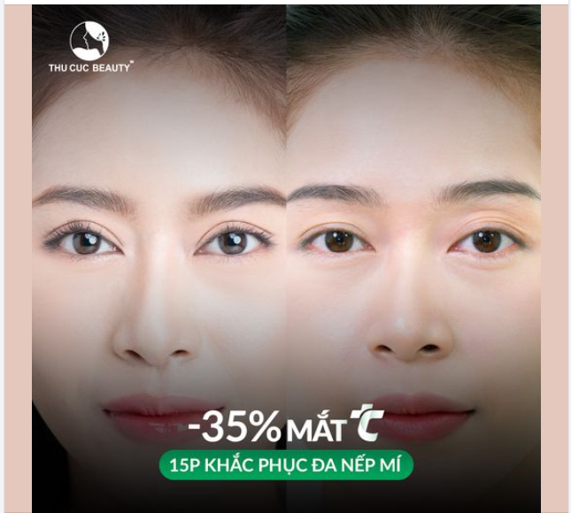 Khắc phục đa nếp mí chỉ sau 15P? Bạn không nhầm đâu!!