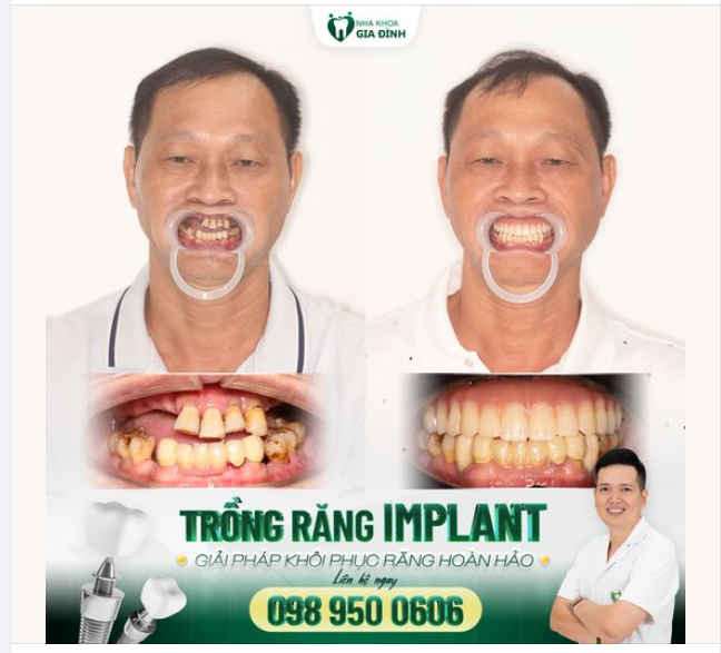 Khám Phá Giải Pháp Trồng Răng Implant All-on-4 tại Nha Khoa Gia Đình!
