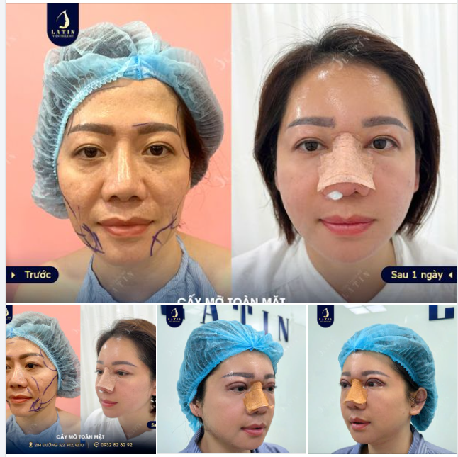 Combo Fullface cho chị khách hàng Việt kiều Mỹ