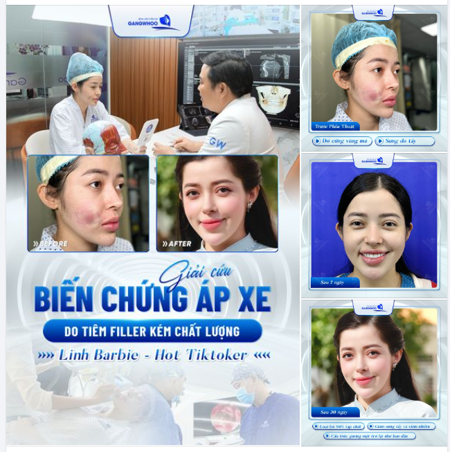 HOT TIKTOKER "LINH BARBIE" GẶP BIẾN CHỨNG SAU 6 NĂM TIÊM FILLER