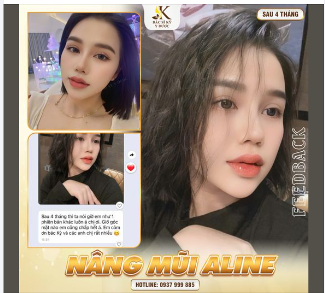 KHÁCH HÀNG “KHOE” NHAN SẮC ĐẸP “HƠN HOA” SAU NÂNG MŨI ALINE