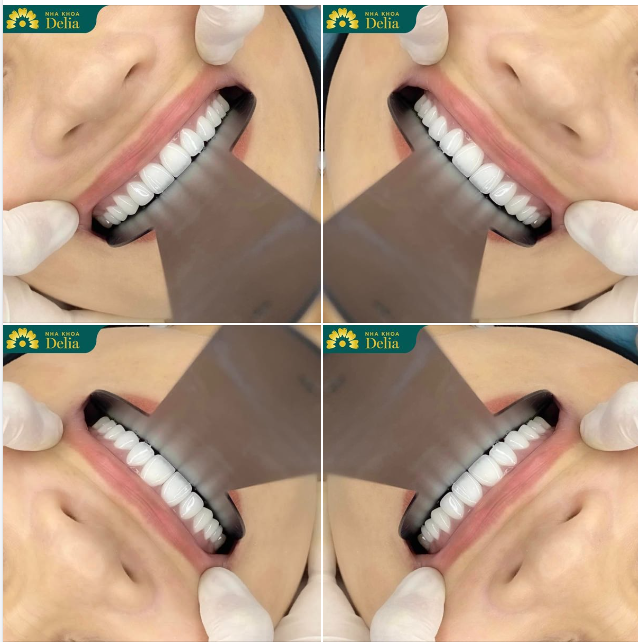 RĂNG THAY ÁO MỚI, TỰ TIN NỞ NỤ CƯỜI