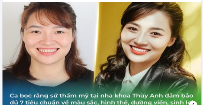 7 TIÊU CHUẨN VÀNG CHO NỤ CƯỜI ĐẸP SAU BỌC SỨ