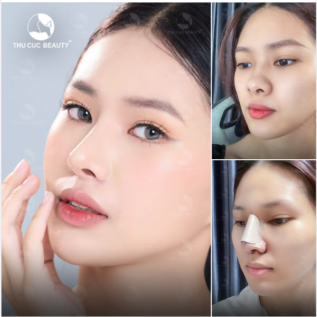 Mũi TC -35% Cân chỉnh sống mũi thấp/gồ/hếch 5 ngày vào form dáng mũi hài hòa gương mặt
