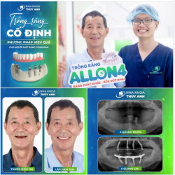 CHỈ VỚI 8 TRỤ IMPLANT, KHÔI PHỤC LẠI TOÀN BỘ 2 HÀM RĂNG CHO CHÚ KHÁCH HÀNG TỪ YÊN BÁI