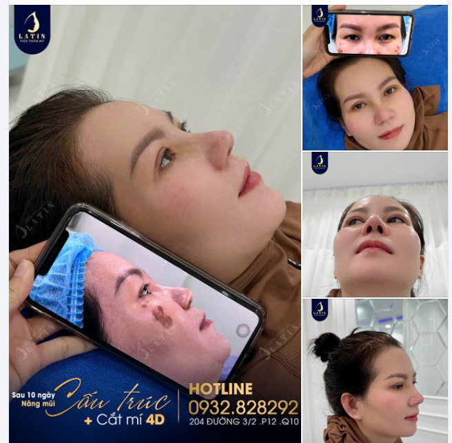 Combo Nâng mũi + Cắt mí sau 10 ngày