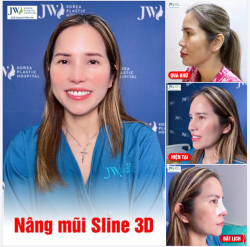 NỮ VIỆT KIỀU TRẺ 20 TUỔI SAU KHI NÂNG MŨI SLINE 3D TẠI JW