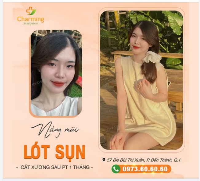 Ta nói, nàng sau 1 tháng nâng mũi lót sụn kết hợp cắt xương tại Charming mà xinh hết phần thiên hạ luôn