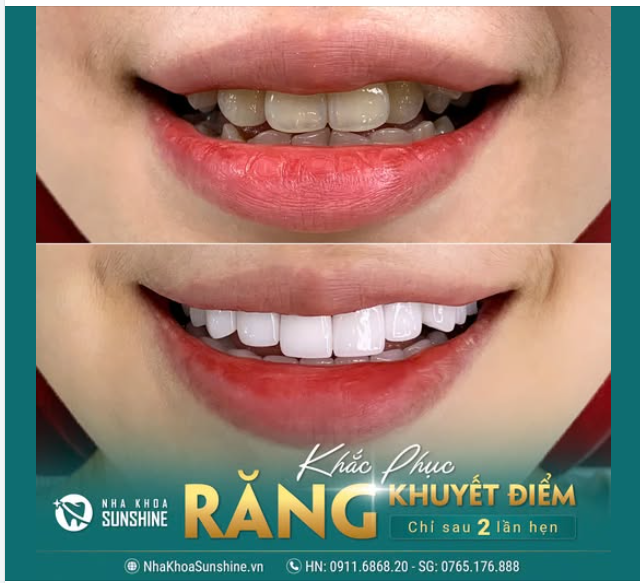 KHẮC PHỤC RĂNG KHUYẾT ĐIỂM CHỈ SAU 2 LẦN HẸN